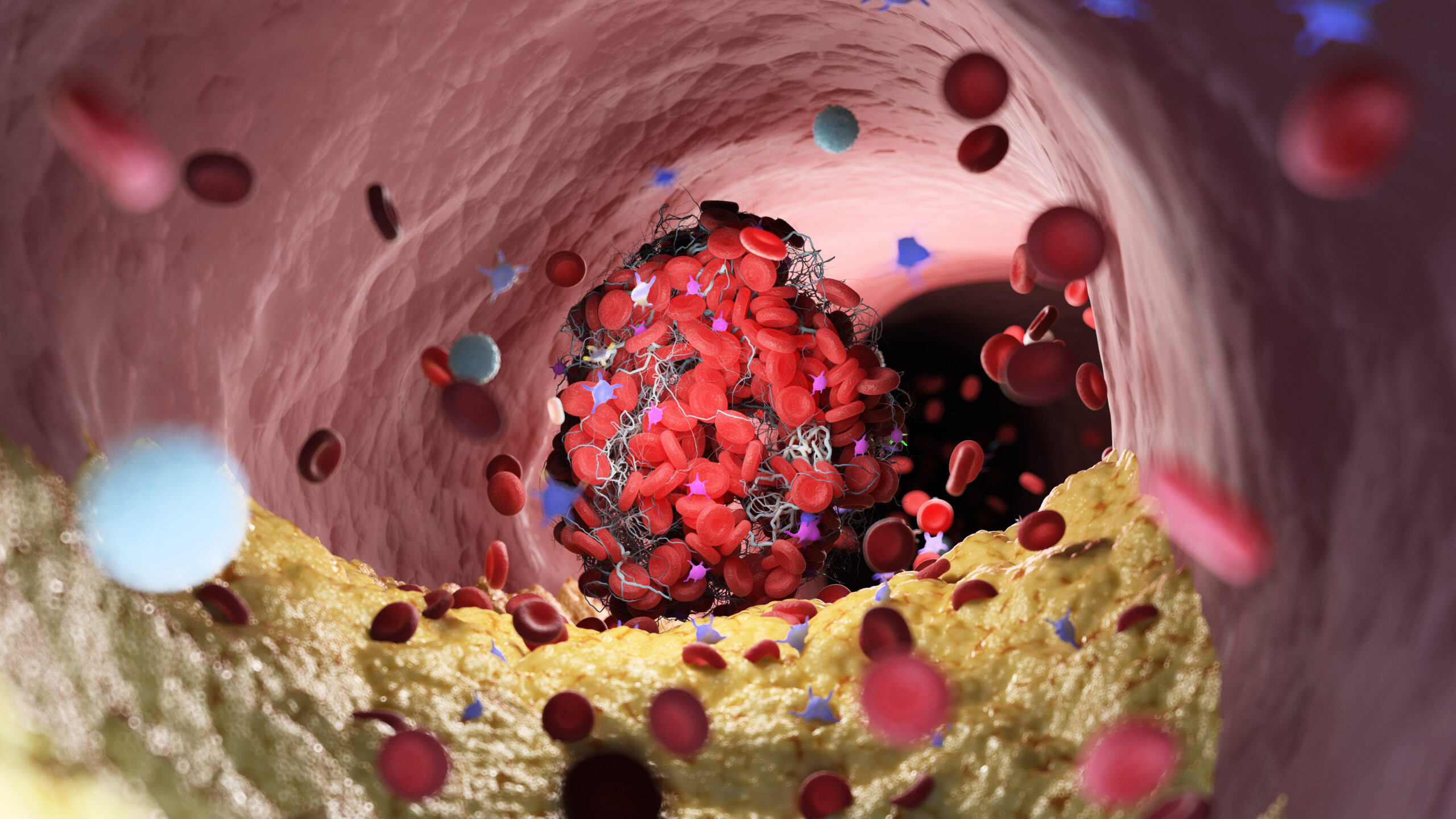 3d rendered illustration of a thrombus 3d rendered illustration of a thrombus